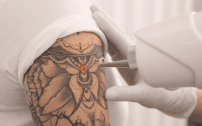 The Tattoo Removal Process: Techniques and Innovations