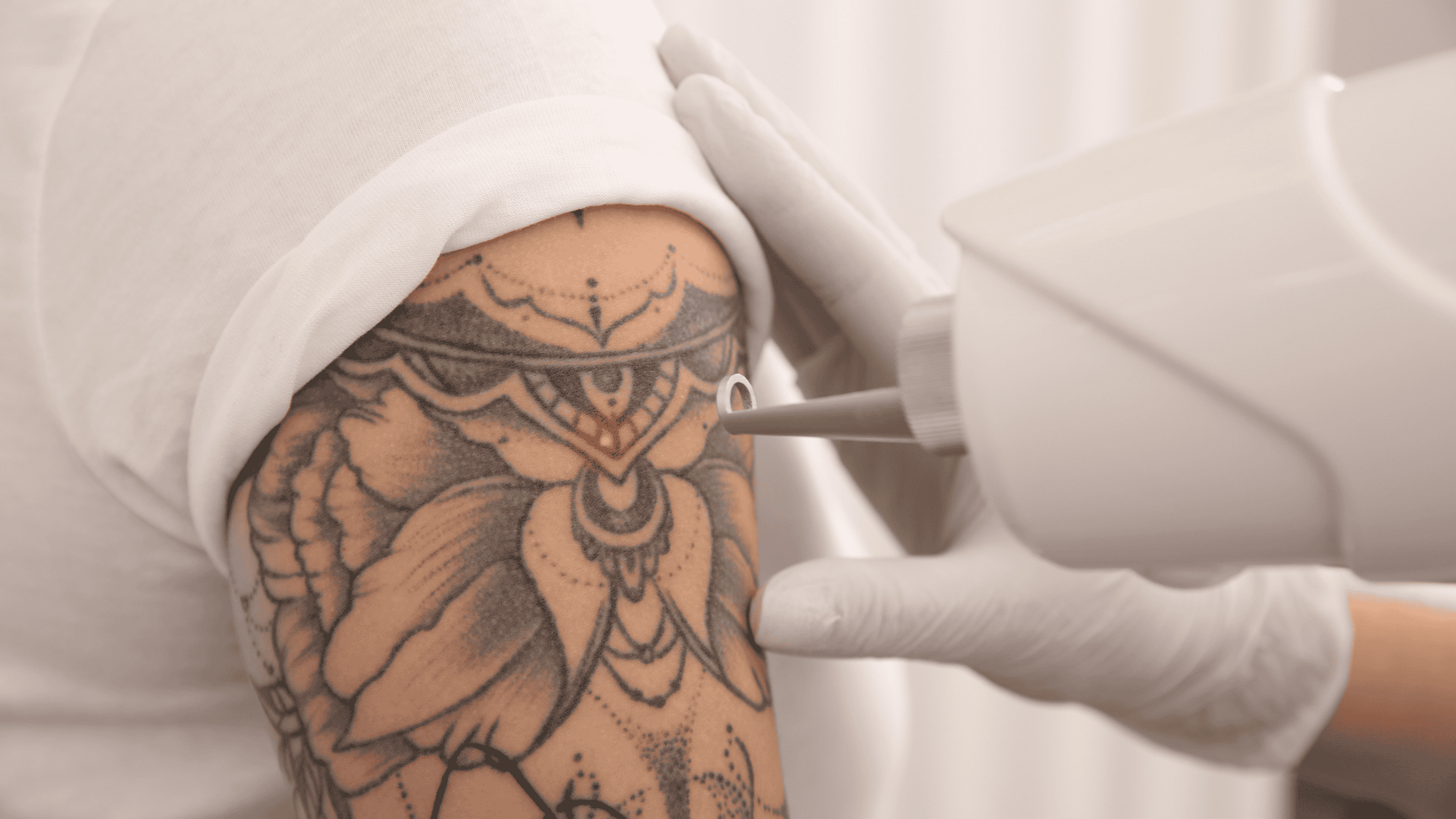 The Tattoo Removal Process: Techniques and Innovations