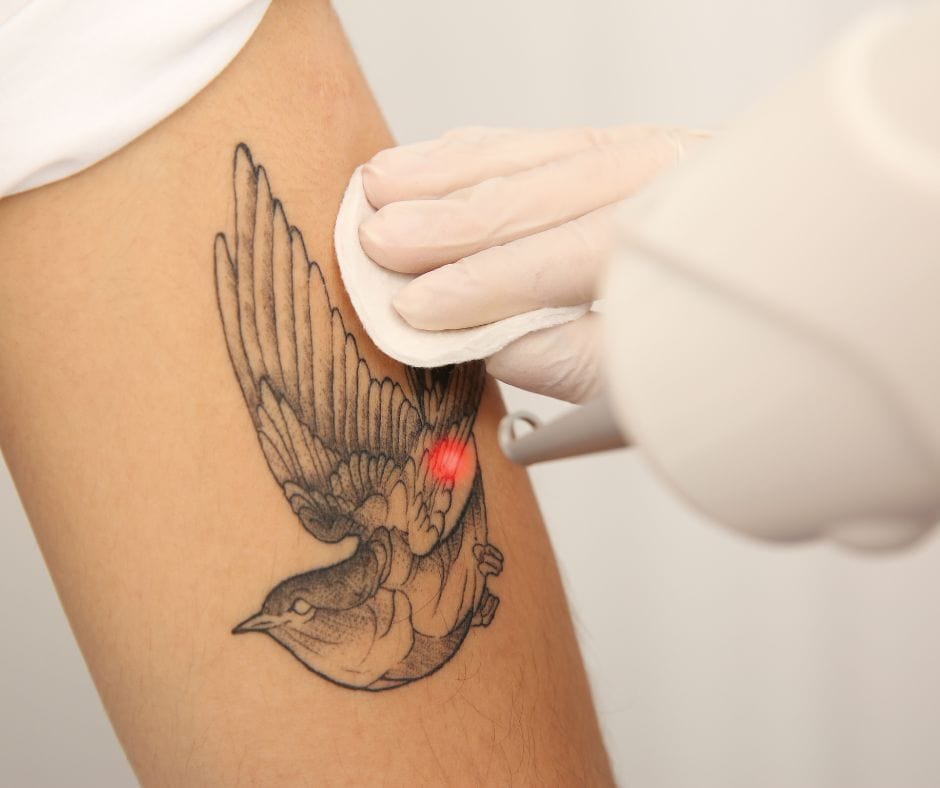 Tattoo Removal: What to Expect from Laser Treatments
